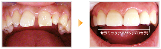 セラミック(プロセラ)を使用して歯の隙間治療前後の写真